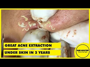 Suri Job 43: GREAT EXTRACTION ACNE UNDER SKIN IN 2 YEARS