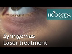 Syringomas - Laser treatment (21024)