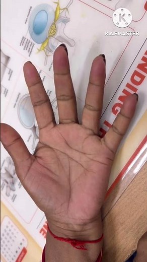 Steroid injection in trigger finger. It is a safe and effective treatment option for trigger finger.