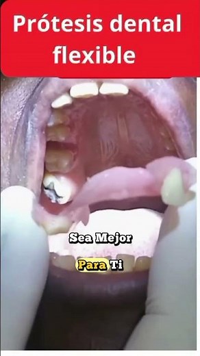 Indicación de las prótesis dental flexibles
