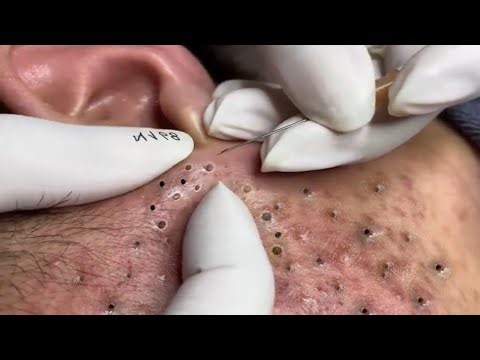 Unbelievably Satisfying Pimple Popping | Relax Every Day | PURE GLOW SPA #0003