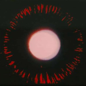 Pigmentary Glaucoma - Glaucoma Research Foundation