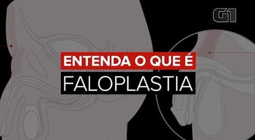 Entenda o que é a faloplastia, cirurgia no pênis pela qual passou o cantor Tiago