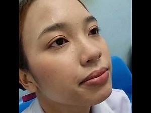 TNE (transnasal esophagoscopy)