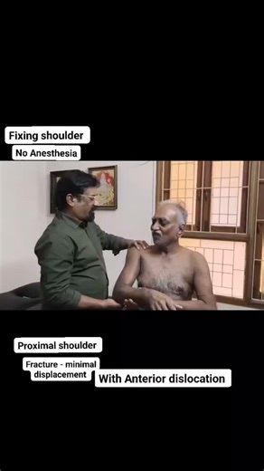 Dharmesh Kubendiran on Instagram: "Proximal humerus fracture with minimal displacement and Anterior dislocation A shoulder fracture-dislocation occurs when the humerus bone (upper arm bone) is both broken and forced out of the shoulder joint. It is a serious injury with symptoms including severe pain, swelling, numbness, weakness, and a visible deformity. Treatment typically involves closed reduction to realign the joint, followed by surgical intervention if needed to fix the fracture, and a len