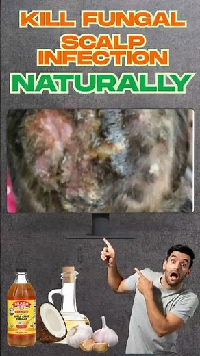 Kill Fungal Scalp Infection NATURALLY With These Remedies #shorts