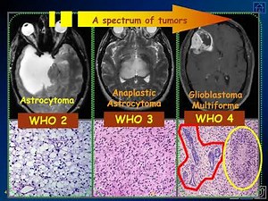 MedPix Video - Diffuse Gliomas