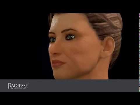 Watch exactly how Radiesse Volumizing Filler works!
