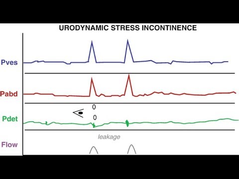 Racial predisposition to Urodynamic Stress Incontinence USI