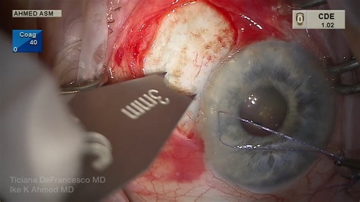 PRESERFLO MicroShunt Procedure