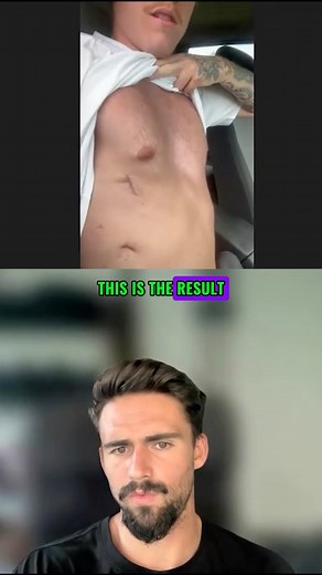 Pectus Excavatum Specialised Trainer on Instagram: "Jackson’s pectus surgery story is an insightful look into the pain, recovery, pros & cons, and what to realistically expect from surgery. The full video is now live on my YouTube channel called PectusPT 🎥 #pectuspt #pectuswarriors #pectusexcavatum #sunkenchest #fixpectus #exercise #stretchesforpectus #exercisesforpectus #vacuumbell #pectusbodybuilding #pectusexcavatum?"