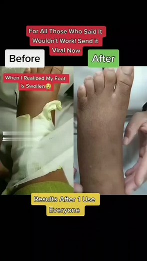 Natural Remedies for Swollen Feet and Joint Pain