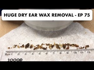 HUGE DRY EAR WAX REMOVAL - EP 75