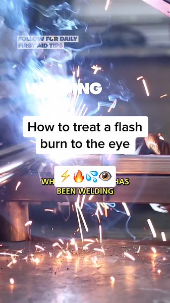 How to treat a flash burn. How do you treat a welding eye injury? #edutok #medtok #eyewash #eyecare #healthtok #nurse #fyp #learnontiktok