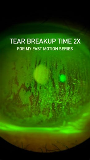 Eyecapp Ophthalmology Atlas 👁 on Instagram: "In this eye with ocular surface disease, we can clearly see punctate keratitis and an interesting finding: a double break-up pattern of the tear film, reflecting instability of different tear film layers. This matters. Especially in a patient about to start glaucoma therapy. Pre-treating the ocular surface is not optional—it’s essential. Many topical glaucoma medications can worsen ocular surface disease, compromise adherence, and affect visual quali