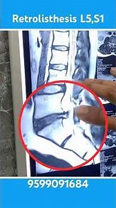 Retrolisthesis L5,S1 without surgery and medicine chiropractic treatment #chiropractormoradabad