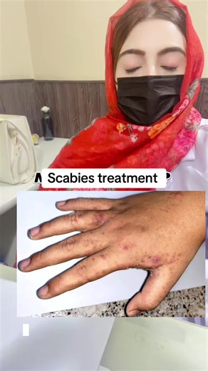 Effective Scabies Treatment for Relieving Itching