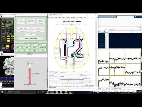 Realignment and framewise displacement | SPM | MATLAB | Resting-state fMRI data | AFNI