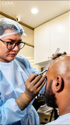 How We Design a Hairline That Looks Completely Natural #hairtransplant #beforeandafter