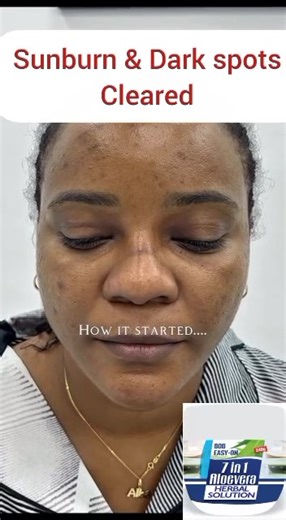 ✨ Breathe Life Back Into Your Skin — Naturally ✨ Are you tired of covering up with makeup, filters, or long sleeves because of stubborn skin problems? Whether it’s keloid bumps, acne, eczema, dark spots, stretchmarks, or skin tags, we know how exhausting it feels when nothing works. Now, relief is finally here. 🌿 Introducing the 7-in-1 Aloe Vera Herbal Skin Solution Cream — a rich, all-natural blend of nature’s most powerful herbs, carefully crafted to heal, restore, and transform your skin gen