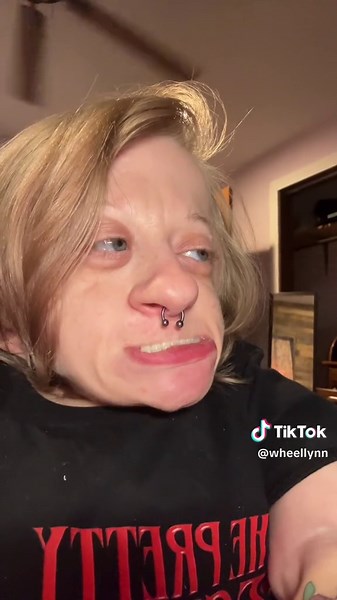 Understanding Dentinogenesis Imperfecta and Dental Disorders