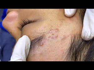 Relax every day with sec dep spa | blackheads removal and pimples popping ep 48