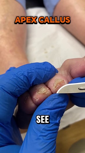 Effective Callus Removal for Toe Pain Relief
