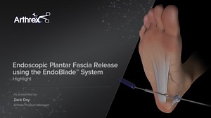 Endoscopic Plantar Fascia Release using the EndoBlade™ System