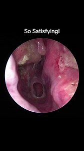 How Did This Get Stuck So Deep? 😲 One of the most satisfying endoscopic removals we’ve seen. Watch until the end to see this amazingly satisfying booger extraction! #medicaltiktok #oddlysatisfying #nose #deepclean #doctor