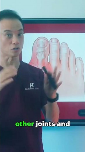 Gout Pain Worse Than Childbirth?! 😳 #shortsvideos #gout #goutrelief