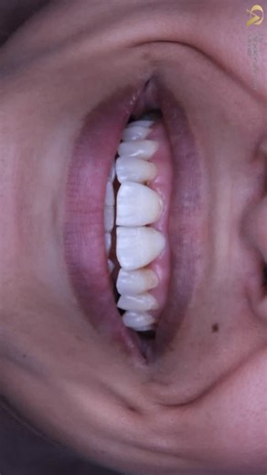Dr.Abdelrahman on Instagram: "Someone regained her self-confidence 🤍 The patient visited the clinic, deeply concerned about the shape and proclination of her teeth. “For the past ten years, I couldn’t smile because of how my teeth looked. It has a huge effect on my self-confidence. I just want a better, natural smile,” she explained. Although orthodontic treatment was the ideal first step, the patient declined it. Instead, we transformed her smile prosthetically using a combination of crowns an