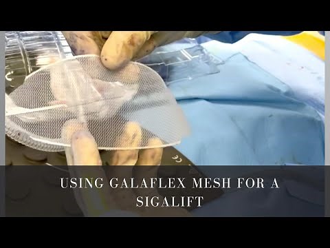 Using Galaflex Mesh for a Sigalift