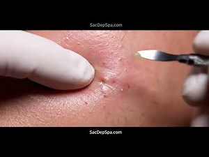 The ULTIMATE Blackhead & Whitehead POPPING Session (Warning: Addictive!)​​ #4