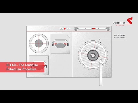 CLEAR – The new Lenticule Procedure by Ziemer