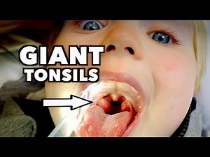 HELP! My Child's Tonsils Are So Big He Can't Breath at Night