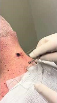 Dr. B Shows Mohs Surgery on Basal Cell #basalcell #mohs #skincancerawareness