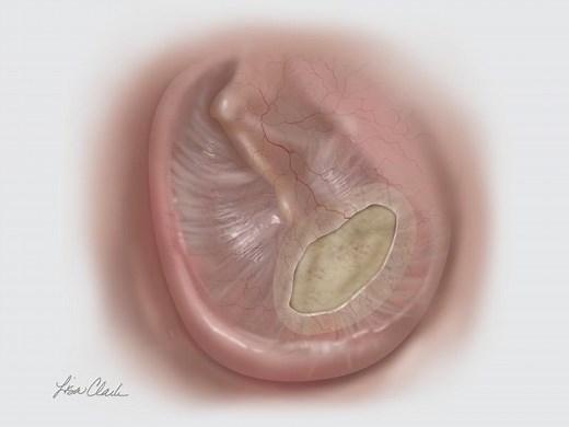 Biodesign® - Otologic Tissue Repair Graft - CCMed