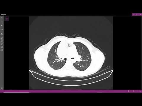 Teratoma mediastinal