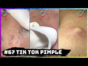 #67 TIK TOK PIMPLE VIDEO COMPILATION US UK | 30th August 2020