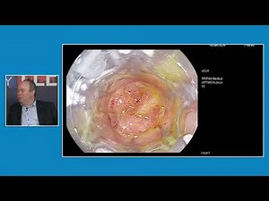 LLE24 Highlights: Steris Padlock Endoscopic closure of fistula