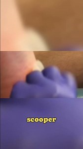 Understanding Blunt Excision Technique! 🩺 #WartRemoval #podiatry #medicalprocedures #dermatology