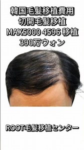 韓国毛髪移植、切開毛髪移植MAX5000 4596 移植390万ウォン#毛髪移植#毛髪移植費用