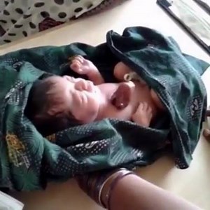 326 reactions · 278 shares | Ectopia cordis (Greek: "away/out of place" + Latin: "heart") is a congenital malformation in which the heart is abnormally located either partially or totally outside of the thorax. The ectopic heart can be found along a spectrum of anatomical locations, including the neck, chest, or abdomen. In most cases, the heart protrudes outside the chest through a split sternum. | Meddy Bear | Facebook