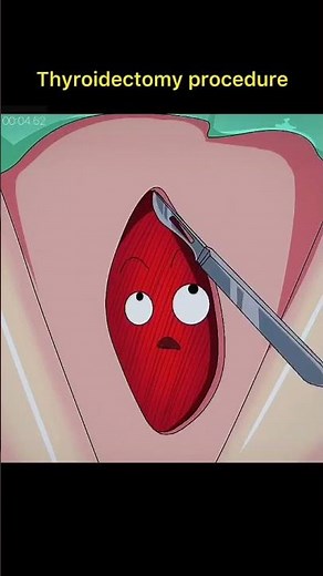 Thyroidectomy procedure