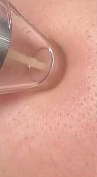 Deep Pore Cleansing: Blackhead Extraction with a Vacuum Tool