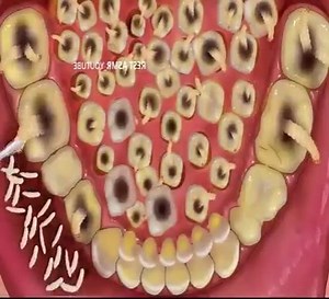 ASMR Removes too many teeth & maggots | Asmr Treatment