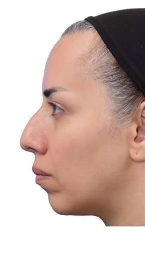 Omid Keyhan on Instagram: "This patient had retrognathia & bimaxillary protrusion with convex profile & gummy smile due to vertical maxillary excess so in such situations the ideal treatment of choice is orthognathic surgery but due to patient desires we just considered jumping genioplasty & simultaneous rhinoplasty to creat better profile view . Based on our new theory regarding facial rings & slings as you can see following the changes in chin & nasal area the amount of gummy show has been dec