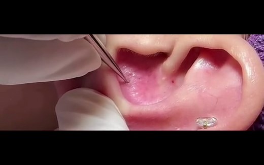 Professional ear blackhead removal video! #blackhead #blackheads #blackheadsremoval #skincare #skin #tiktok #fy #fyp #fypシ #skincareasmr