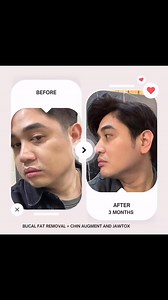 Define Your ProfileGet ready to contour your way to a sharper jawline and chin! Our exclusive deal includes:✨Buccal Fat Removal: Slim down your cheeks for a more defined face✨Silicon Chin Augmentation: Enhance your chin shape for a stronger profile✨Jawtox: Relax facial muscles for a more angular jawlineBook now and say goodbye to a soft jawline! ..#JawlineContouring #ChinAugmentation #BuccalFatRemoval #Jawtox #nook #nooktified | @nookphofficial | 09171746665 | Nook Eton Branch | Facebook