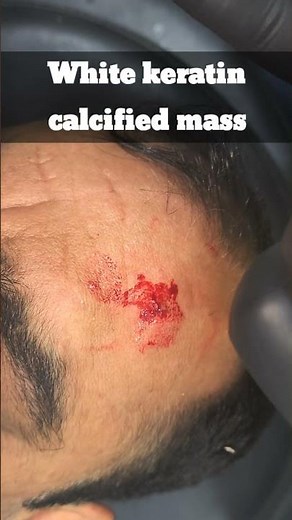 Sebaceous cyst removal forehead ‪@DrArifMDDermatologist‬